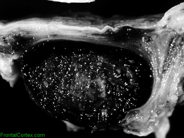 Superior sagittal sinus thrombosis, close-up of sectioned sinus
